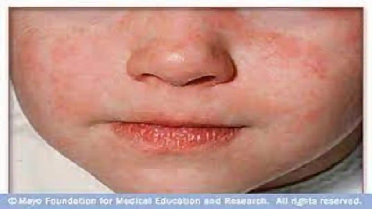 Rubella Bisa Menular pada Anak melalui Percikan Liur, Gejala Penyakitnya? Demam Ruam Diare Ringan