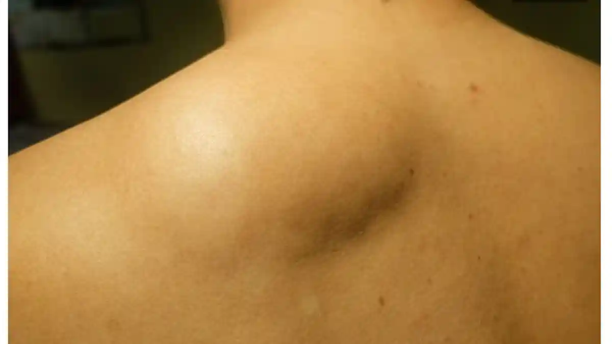 Tak Perlu Operasi, 5 Obat Tradisional Ini Ampuh Mengobati Lipoma Secara Alami