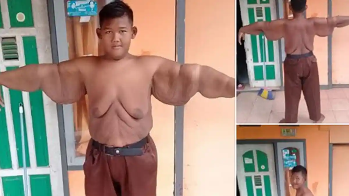 Bocah Ini Kehilangan 100 Kilogram Berat Badannya Berkat Operasi Bariatrik, Begini Hasilnya