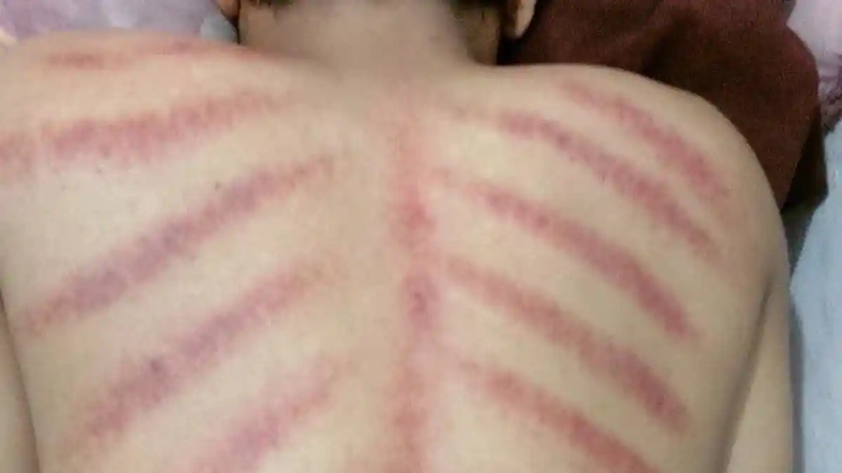 Selain Kerokan, Ini Cara Mengatadi Masuk Angin Tanpa Obat