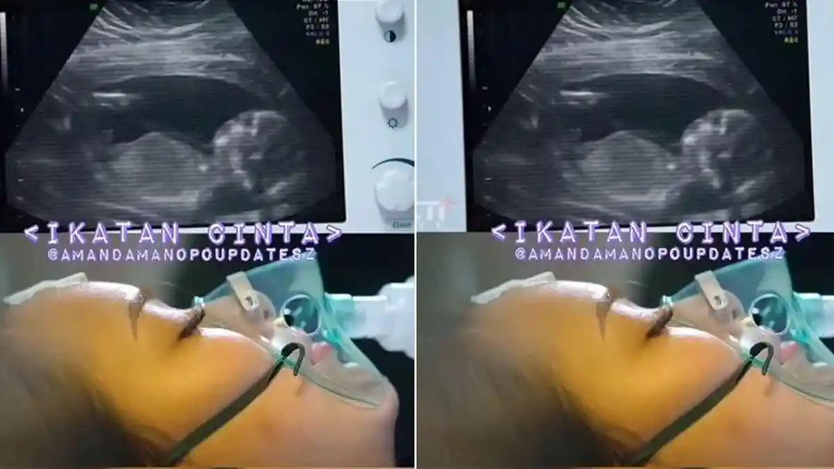 Amanda Manopo Hamil 4 Minggu saat Kritis karena Kecelakaan di Ikatan Cinta