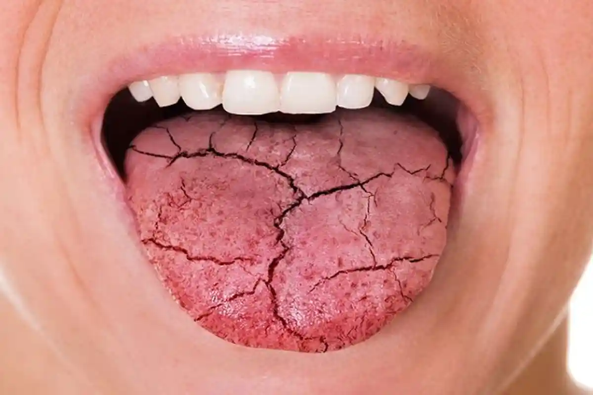 Penyebab Mulut Kering Hingga Berbagai Komplikasi, Gejala Penyakit Xerostomia