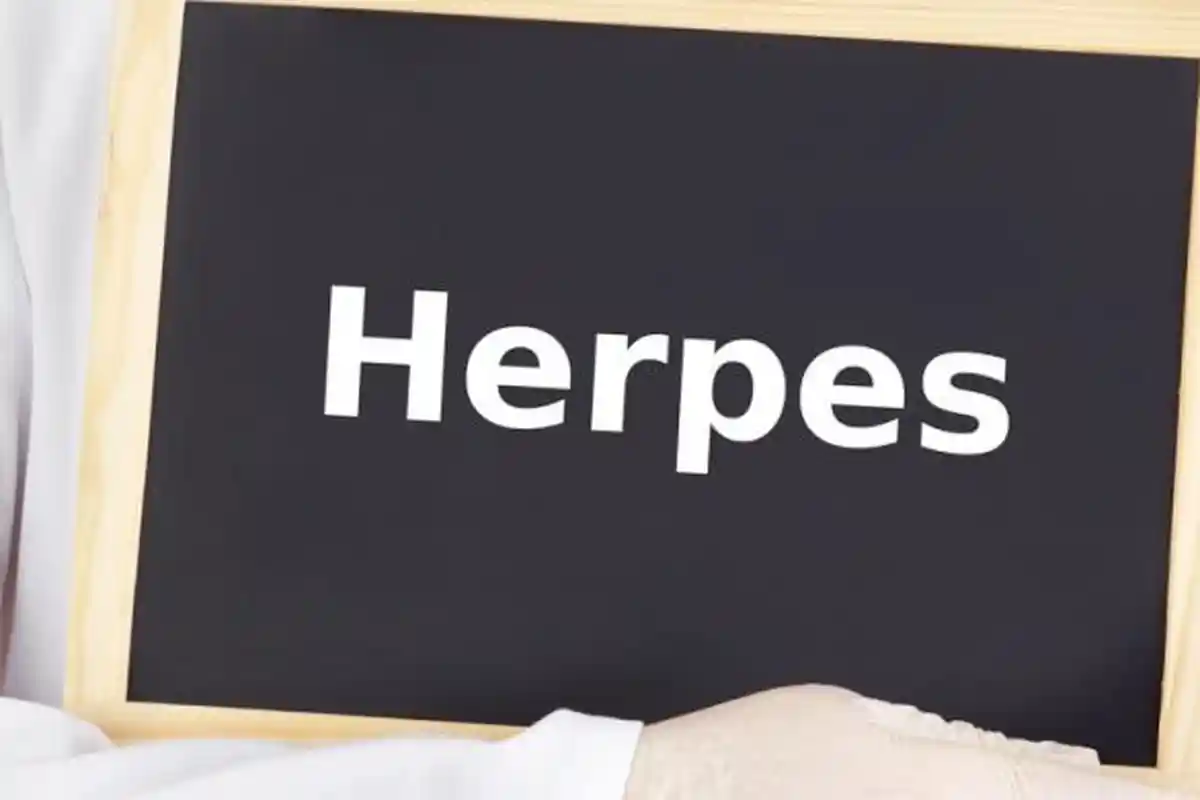 Simak Gejala Herpes yang Tak Boleh Diabaikan