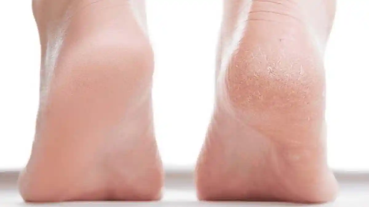 Inilah 8 Cara Mengatasi Tumit Kaki Pecah-pecah Secara Alami (1): Gunakan Getah Pepaya Muda