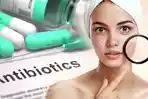 Ternyata Jerawat Bisa Dihilangkan Oleh Antibiotik Lho, Mau Tahu Caranya? Simak Penjelasannya Ini