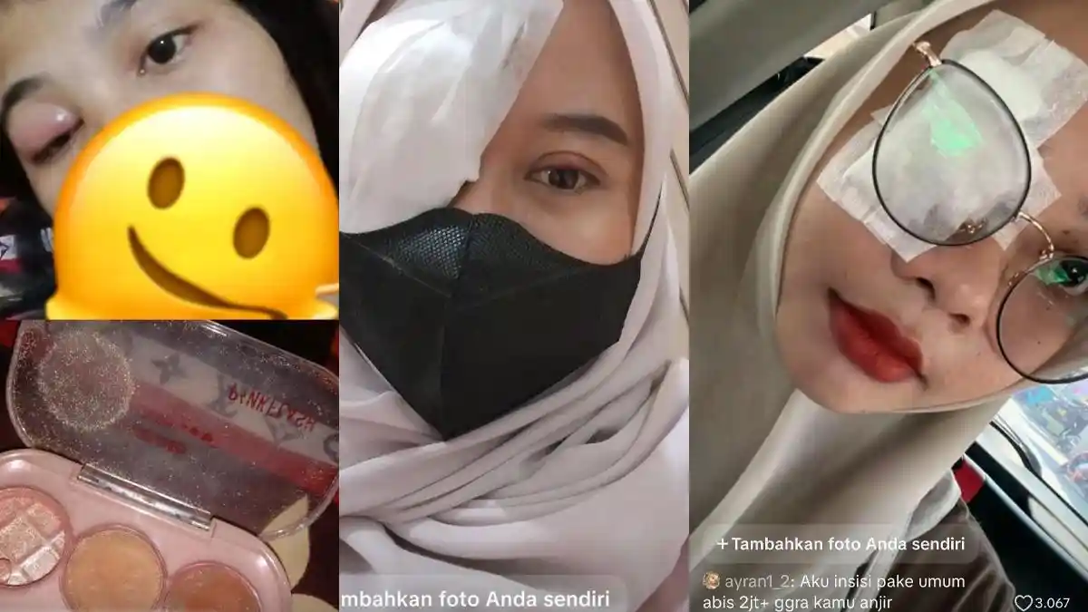 Para Wanita Korban Produk Eyeshadow PINKFLASH hingga Harus Operasi Mata, Brand Langsung Minta Maaf