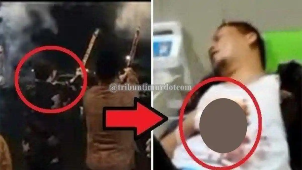 2 Jari Wakil Bupati Kaur Bengkulu Putus di Malam Tahun Baru, Kembang Api yang Dipegangnya Meledak