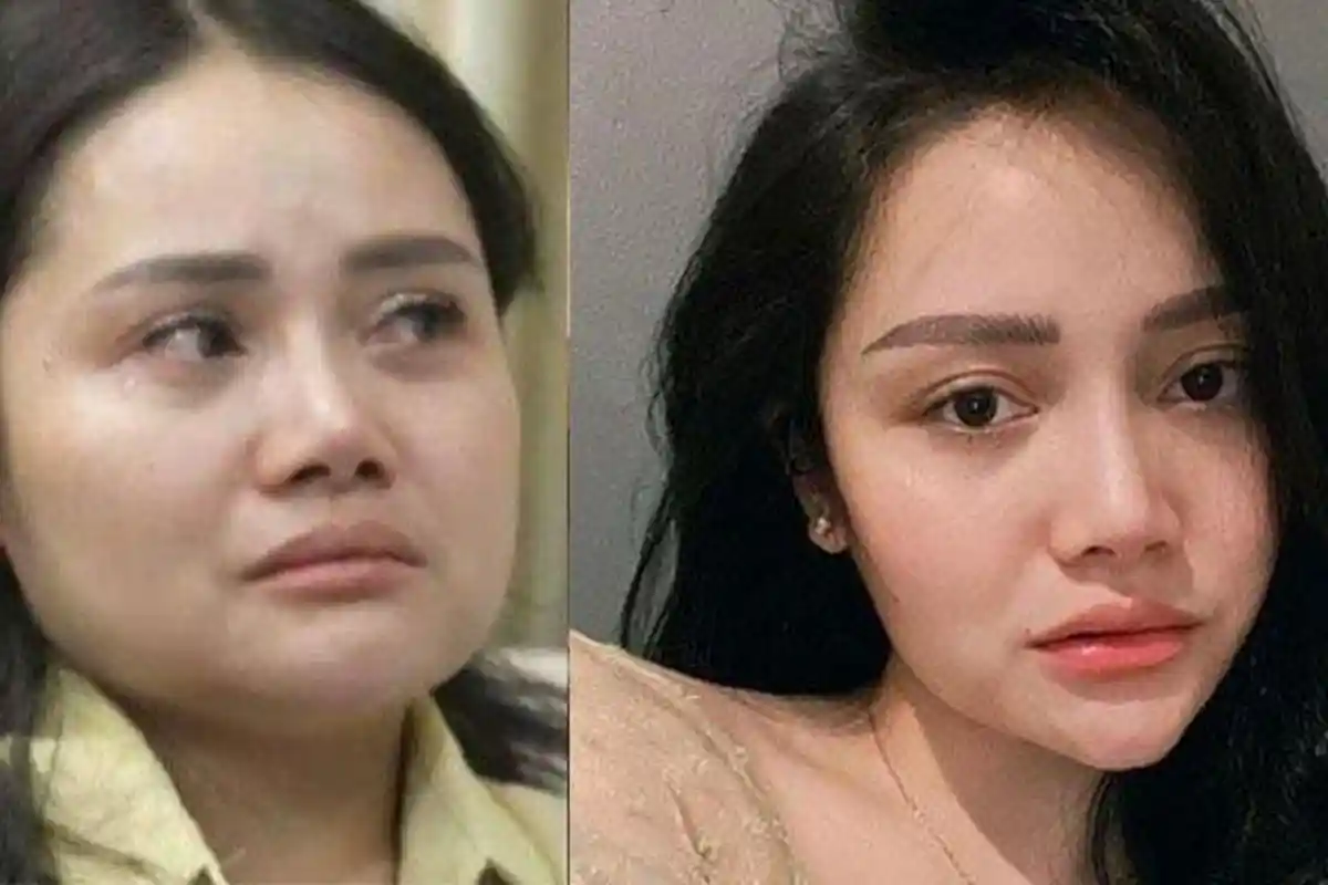 Kondisi Mawar AFI setelah Operasi Wajah Jadi Sorotan, Rahangnya Berubah