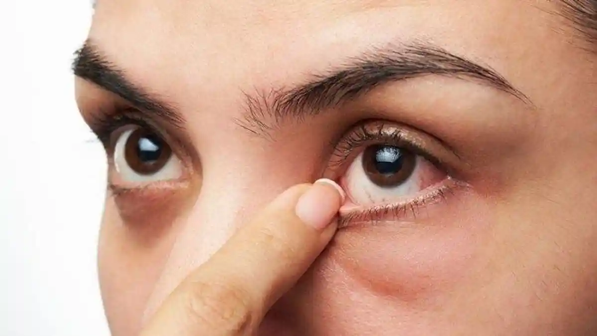 7 Cara Alami Mengatasi Iritasi Mata, Mudah Dilakukan Dirumah
