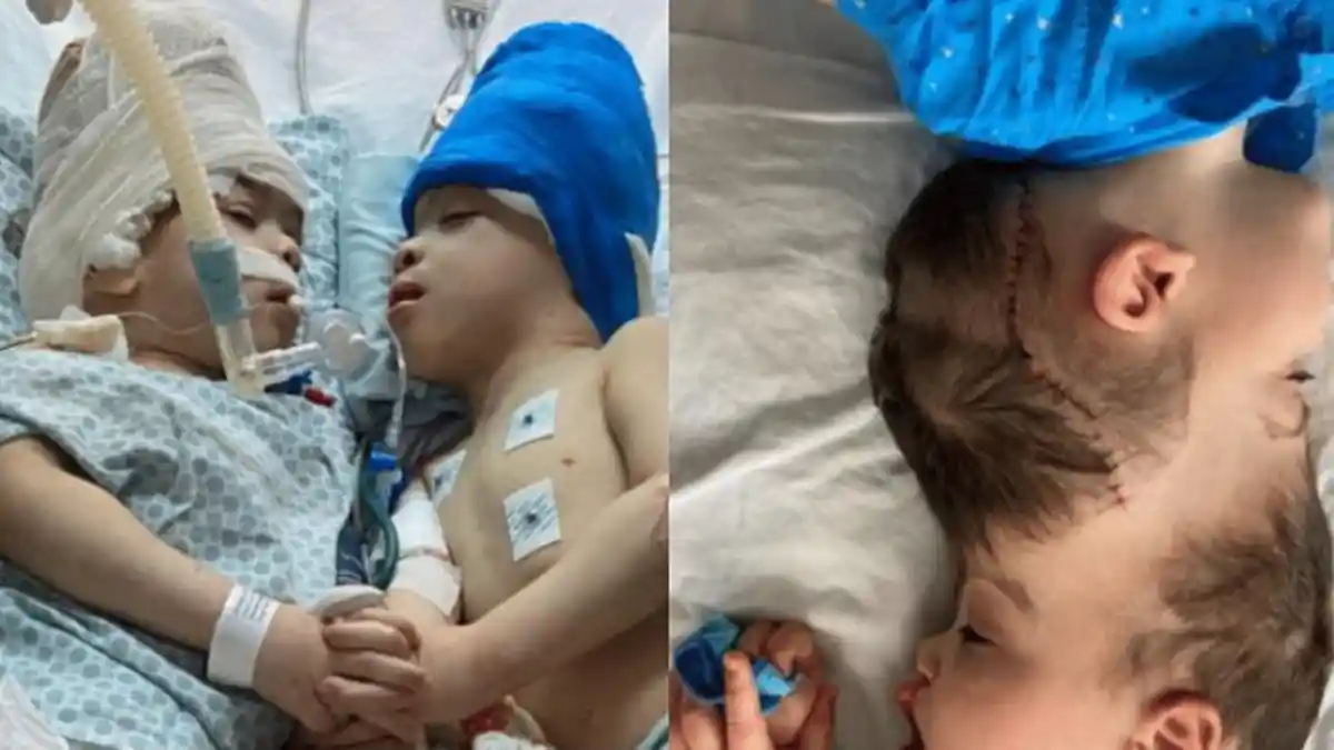 Viral Bayi Kembar Siam Asal Brasil Berhasil Dipisah Lewat Virtual Reality, Kerahkan 100 Staf Medis