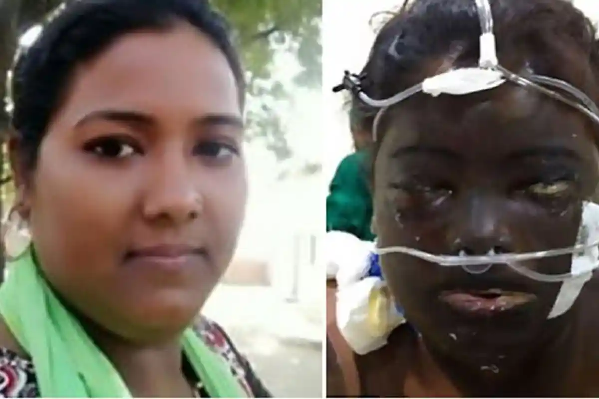 Gara-gara Hal Sepele, Ibu 2 Anak Ini Disiram Air Keras oleh Suami, Nasibnya Jadi Begini