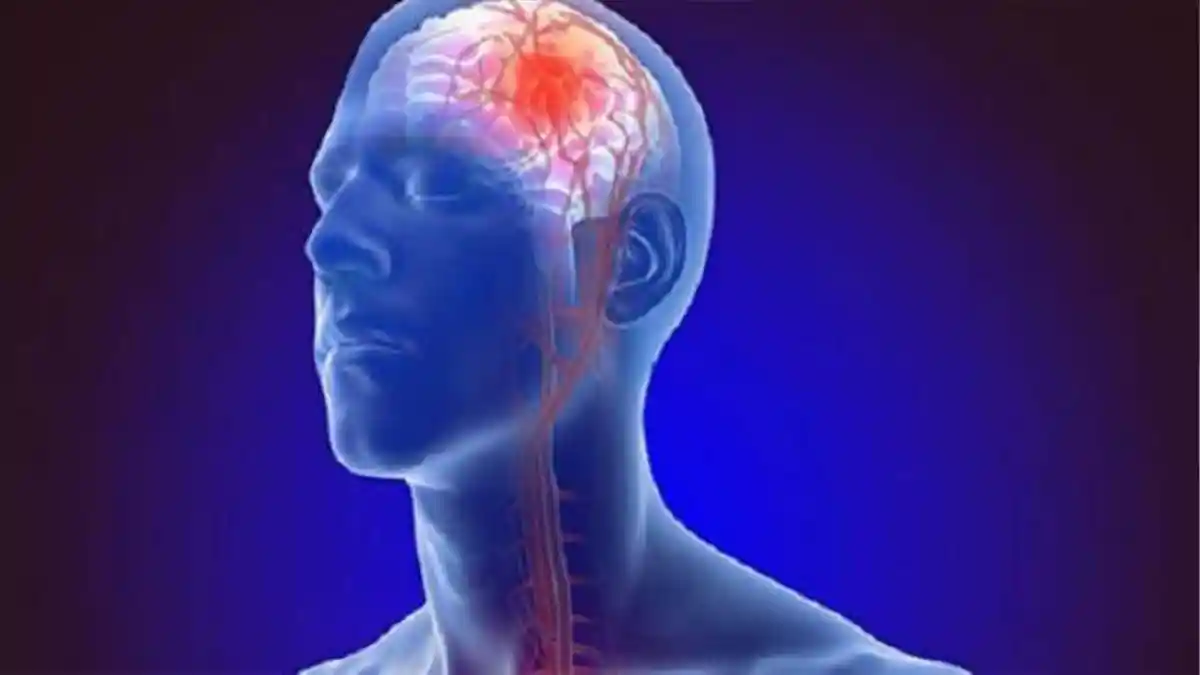 Apa itu Penyakit SH Terjadi pada Otak ? Ketahui Ciri-ciri Stroke dan Jenisnya
