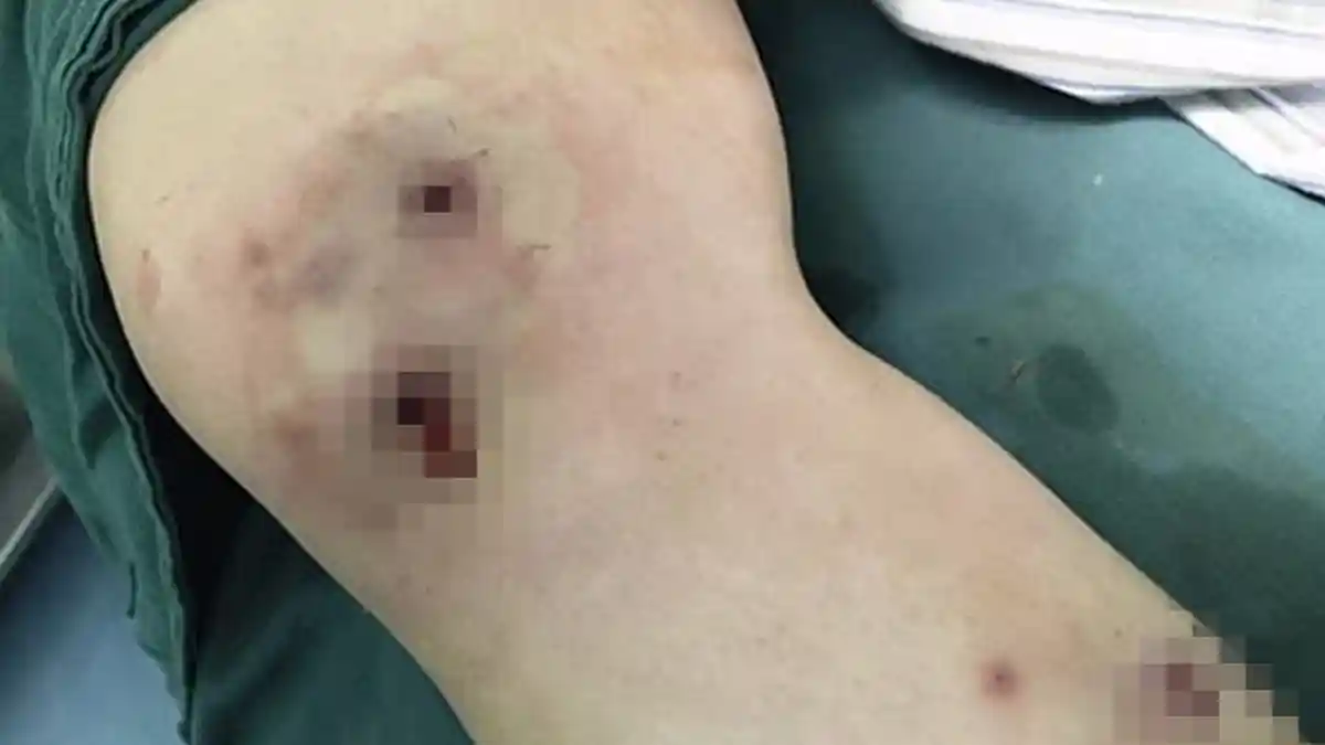 Jangan Anggap Sepele Saat Digigit Serangga! Belatung Bermunculan di Kaki Wanita Ini Setelah Camping
