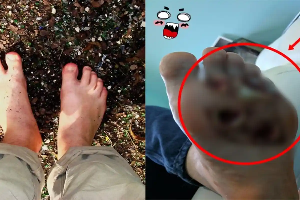 Ini Alasan Kenapa Wajib Pakai Sandal Ke Toilet Umum, Jika Nggak Mau Kakinya Kayak Pria Ini !