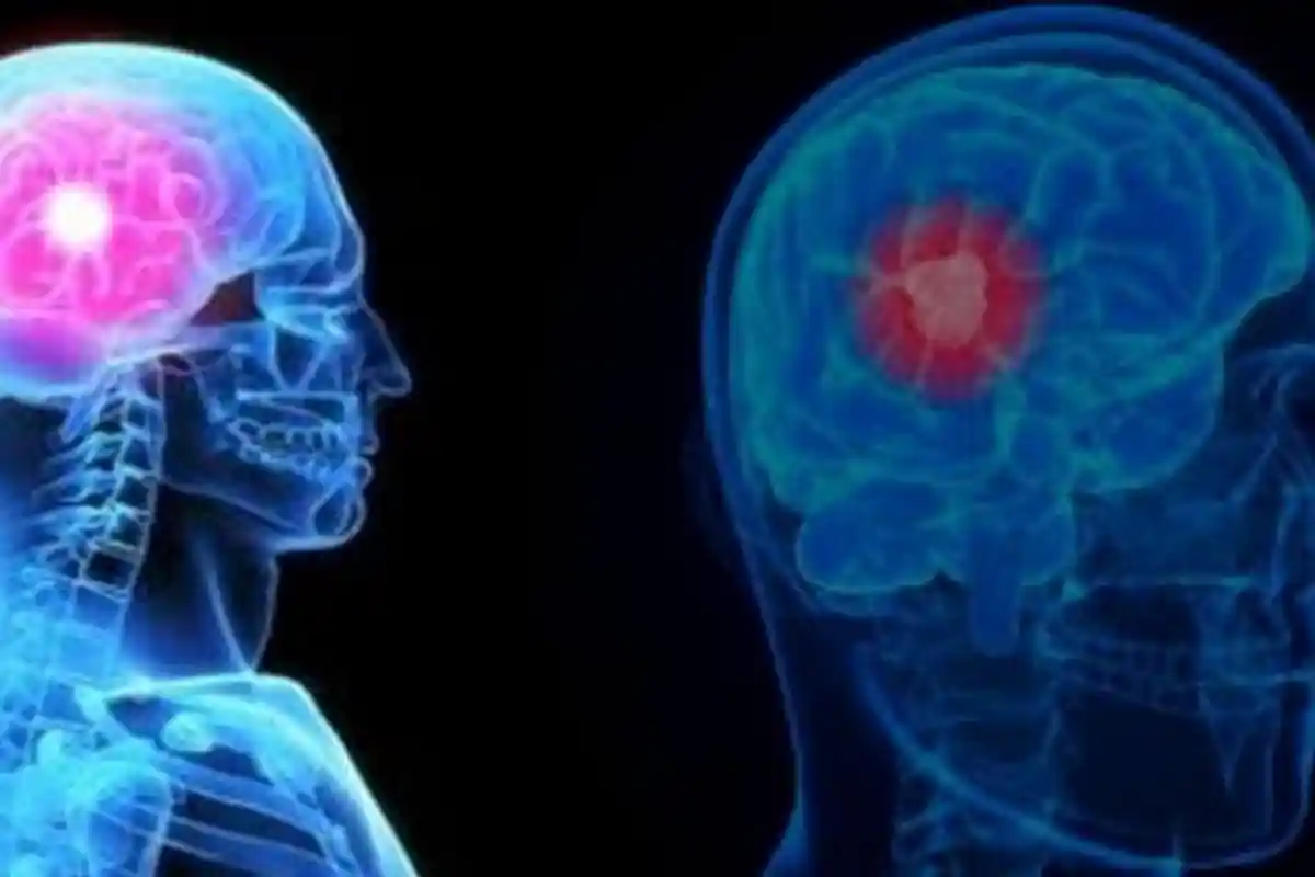 16 Gejala dan Ciri-ciri Kanker Otak Seperti Penyakit yang Merenggut Nyawa Dokter Ryan Thamrin