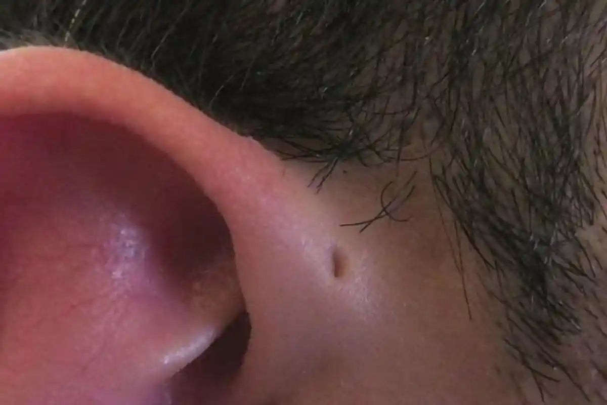 Tips, Cara Mengeluarkan Semut yang Masuk ke Telinga