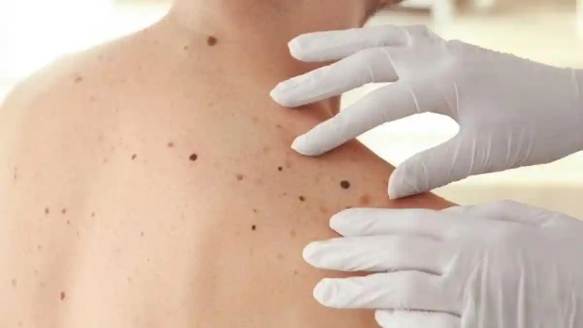 Waspada, Tahi Lalat Ternyata Bisa Menjadi Embrio Kanker Kulit, Kenali Tanda-tandanya Berikut ini!