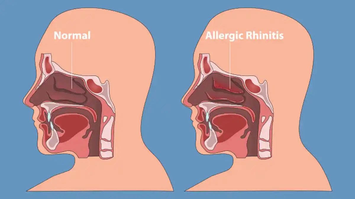 Segala Sesuatu Tentang Rhinitis Alergi, Dari Gejala, Penyebab, Sampai Cara Mengobati