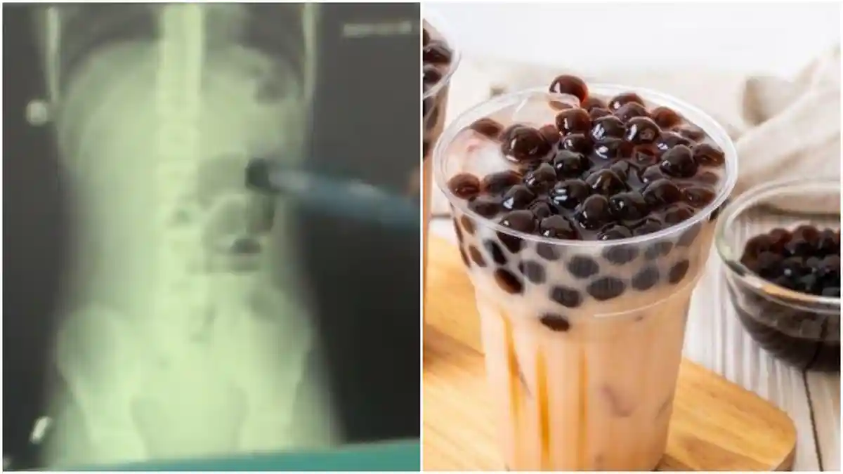 Tak Kunyah Boba Bubble Tea, Usus Bocah 13 Tahun Ini Tersumbat, Simak 4 Tips Ajari Anak Mengunyah