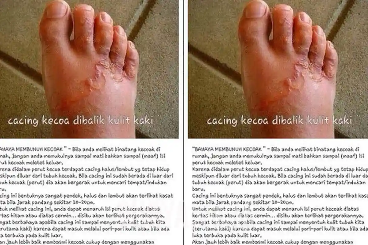 Injak Kecoa Bisa Gatal-gatal Seperti Ini, Beneran atau Hoax Sih?