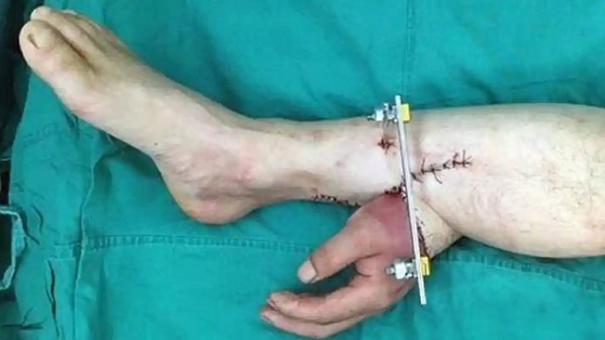 Mengerikan! Tangan Putus Saat Bekerja, Malah Disambungkan ke Kaki