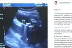 Kabar Mengejutkan, Tiga Batu Bersarang di Empedu Maia Estianty