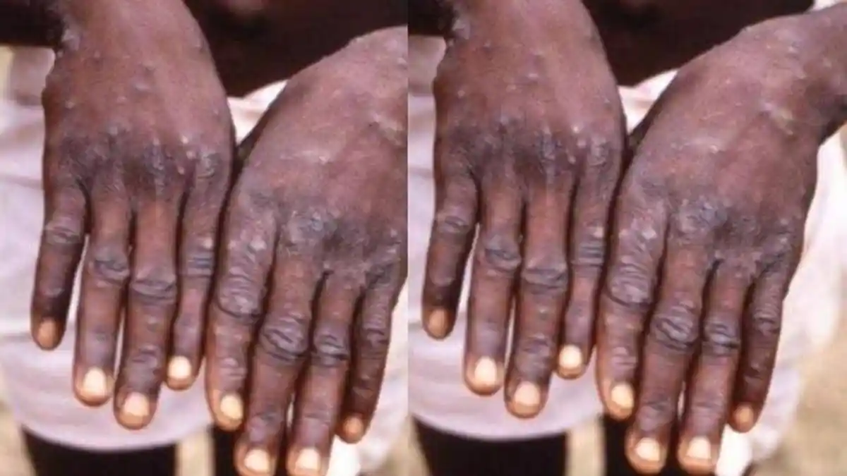 Penjelasan Wabah Monkeypox atau Cacar Monyet, Gejala Mirip Flu, Dapat Menyebar Melalui Kontak Fisik