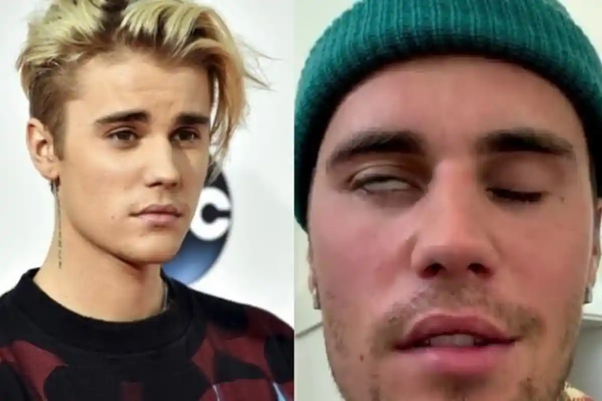 Justin Bieber Telah Sembuh dari Sakit Sindrom Ramsay Hunt, Siap Lanjutkan Tur Dunia
