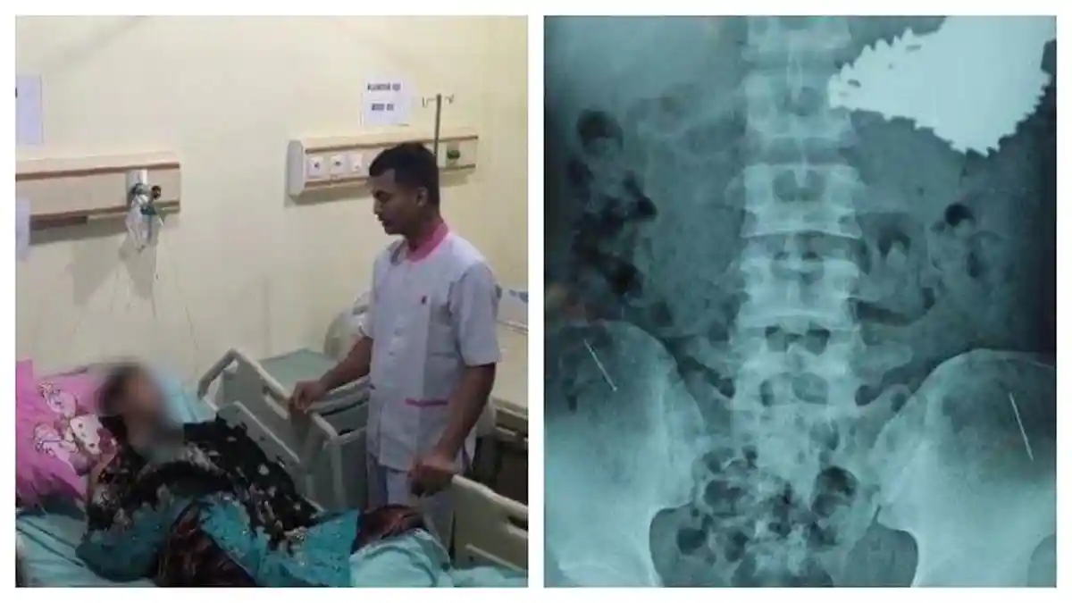 Penampakan 70 Paku yang Bersarang di Perut Pria Indramayu, Punya Kebiasaan Makan Jarum Pentul