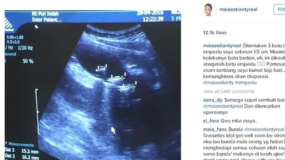 Kabar Mengejutkan, Tiga Batu Bersarang di Empedu Maia Estianty