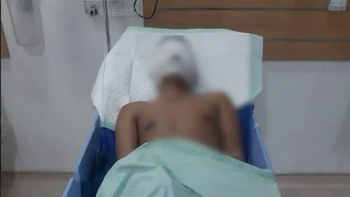 Disiram Air Keras oleh OTK, Mata Wartawan di Medan Alami Peradangan, Wajah Masih Diperban