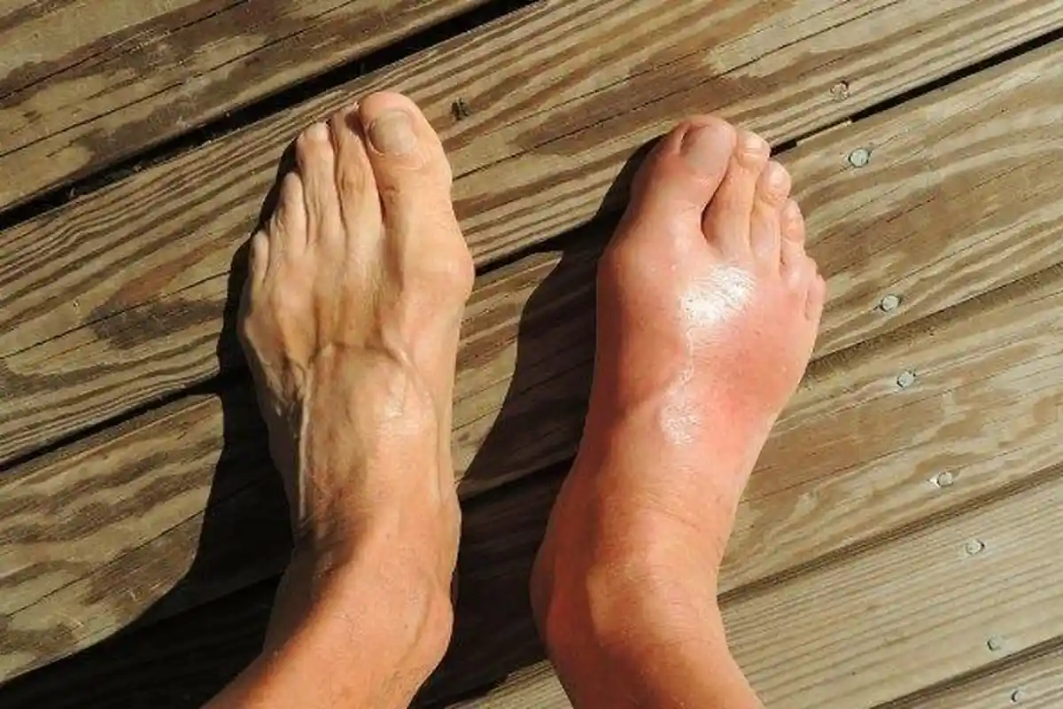 Cek Buah yang Tidak Boleh Dimakan Penderita Asam Urat ! Ketahui Juga Nih Makanan Pantangan Asam Urat