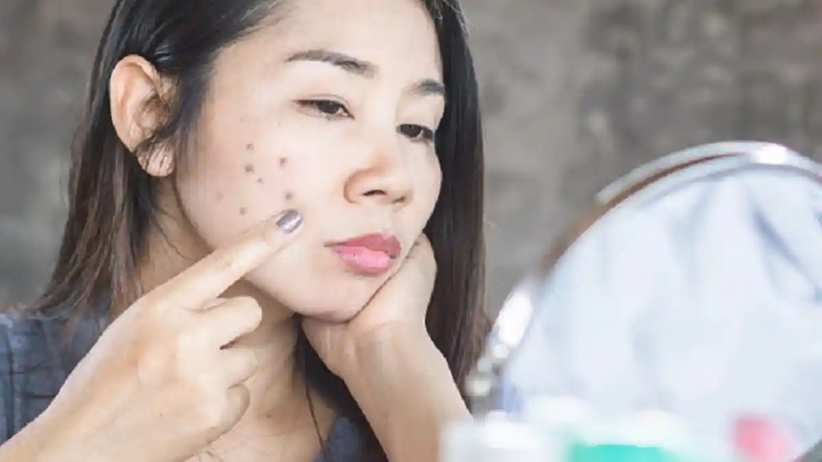 Kenali 4 Jenis Flek Hitam Wajah dan Cara Menghilangkannya, Salah Satunya Rajin Pakai Tabir Surya