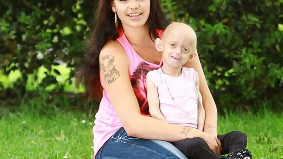 Progeria: Umur 5 Tahun, Tampak seperti Kakek Nenek