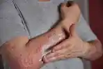 Dulu Dianggap Remeh, Mengapa Kini Campak Menulari Orang Dewasa hingga Berujung Kematian?