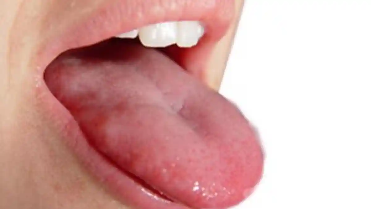 WASPADA Covid Tongue, Gejala Baru Covid-19 yang Mirip Sariawan di Lidah, Simak Ciri-cirinya