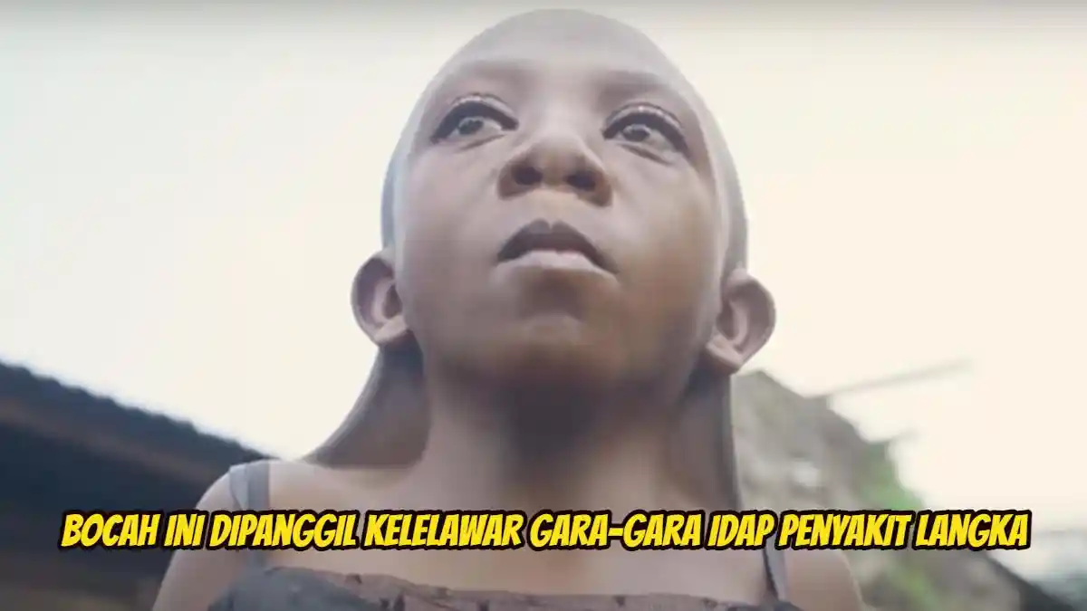 Pilu Bocah Dipanggil Kelelawar Gara-gara Idap Penyakit Langka, Dokter Bingung Lihat Kondisinya