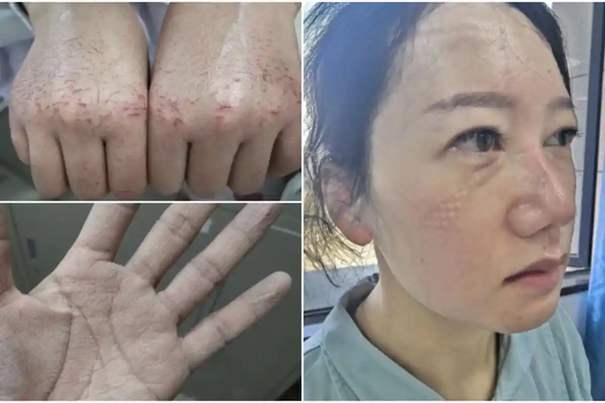 Kondisi Petugas Medis Berhari-hari Rawat Pasien Corona, Tangan Terluka hingga Wajah Membekas Masker