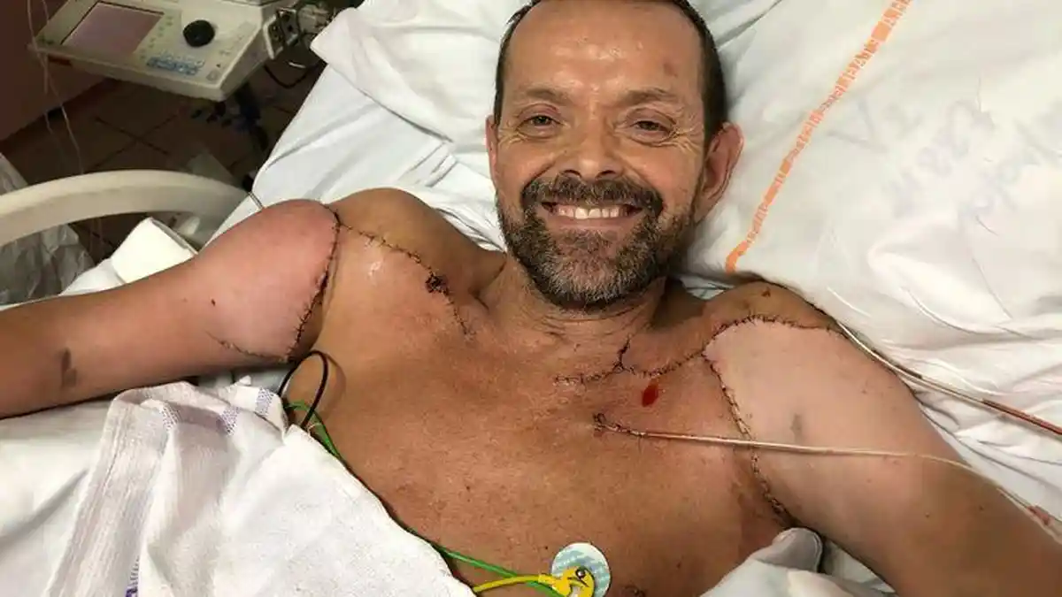 Kisah Felix Gretarsson, Pria Pertama Peroleh Transplantasi Lengan Ganda di Dunia