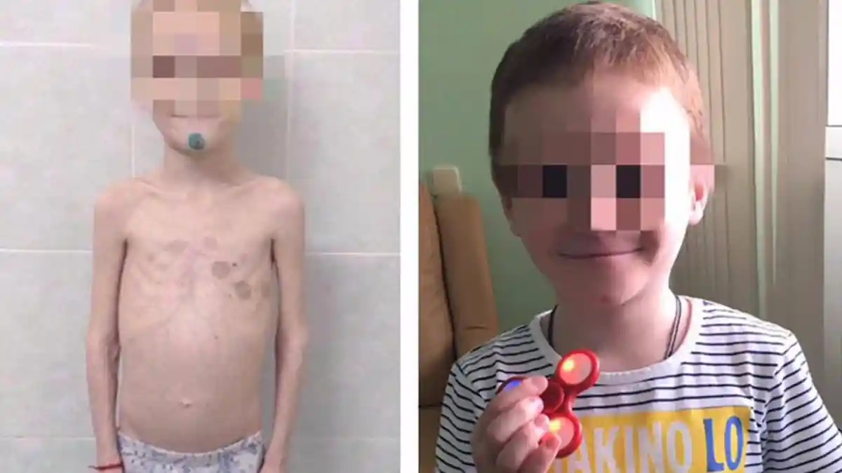 Miris! Ibu Ini Sengaja Buat Anaknya Busung Lapar agar Dapat Uang dari Tunjangan dan Badan Amal