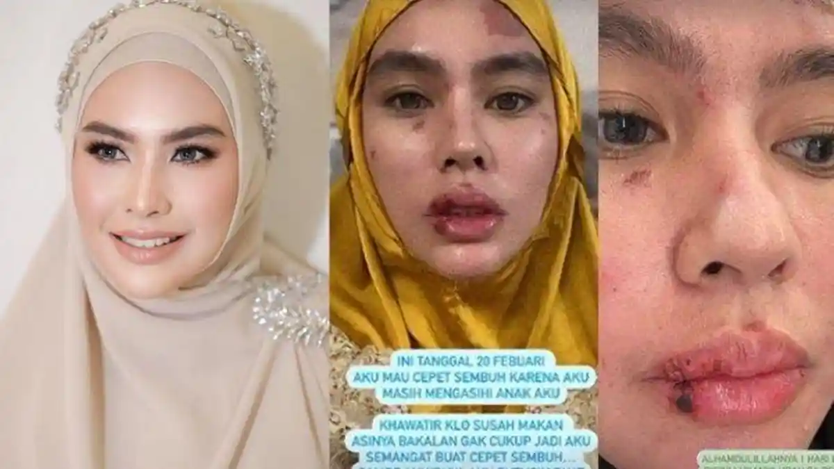 Kartika Putri Ternyata Sudah 5 Tahun Idap Autoimun, Awal Mula Ruam di Muka dan Mulut hingga Melepuh