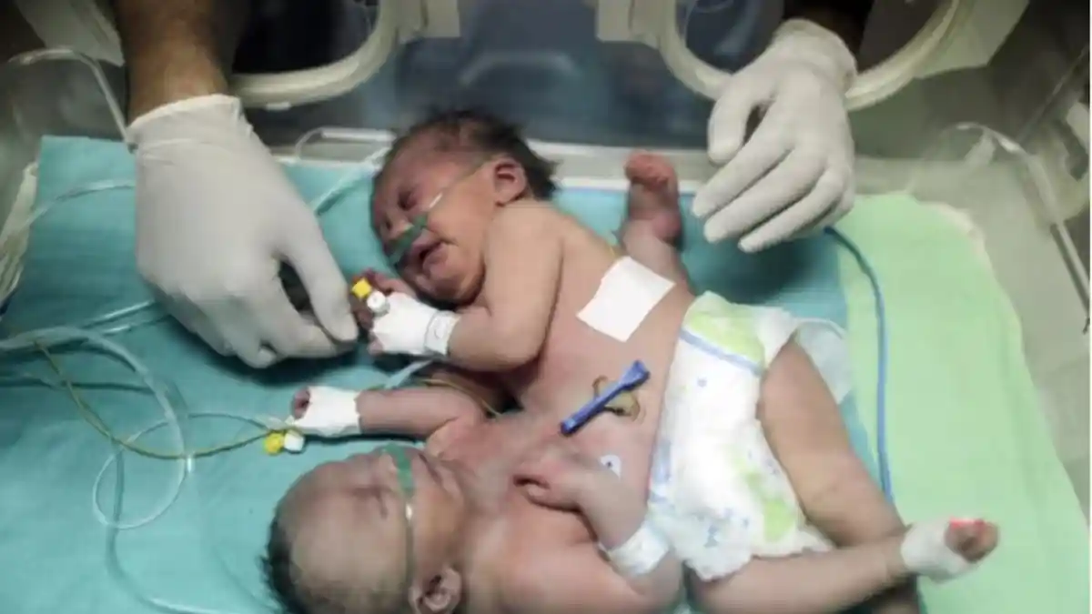 Operasi Pemisahan Bayi Kembar Siam Asal Palestina Berhasil Dilakukan di Riyadh