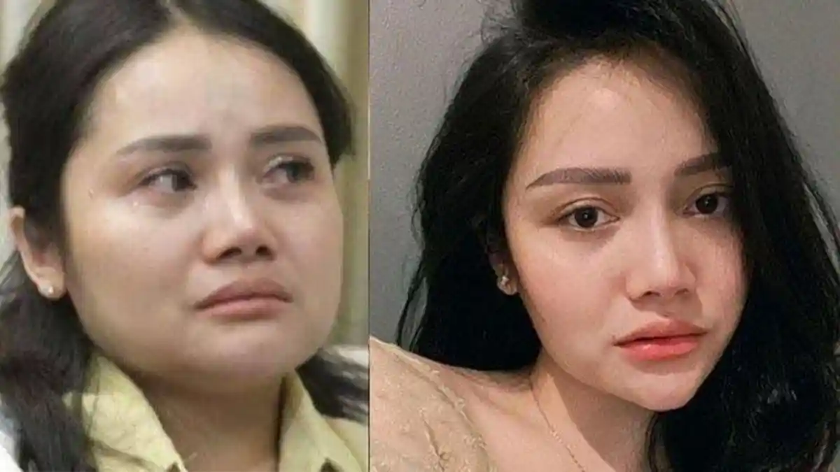 Kondisi Mawar AFI setelah Operasi Wajah Jadi Sorotan, Rahangnya Berubah