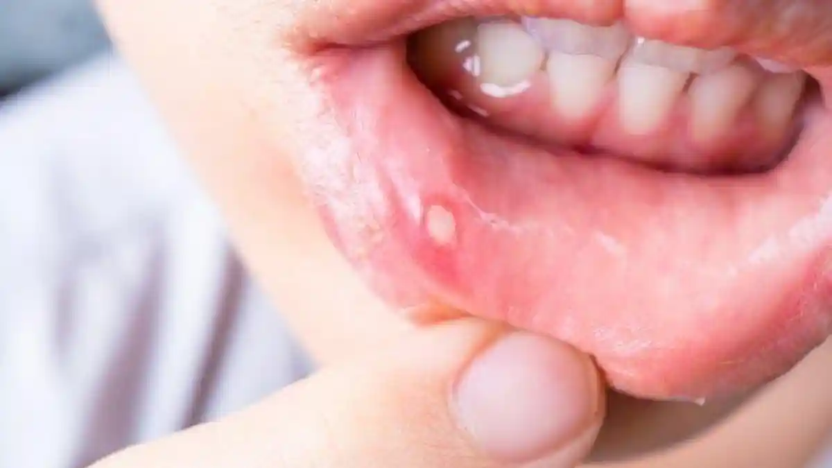 Sariawan Saat Sedang Puasa? Ikuti Tips Mengatasinya dari Dokter RS JIH Solo Agar Sahur Lebih Afdol!