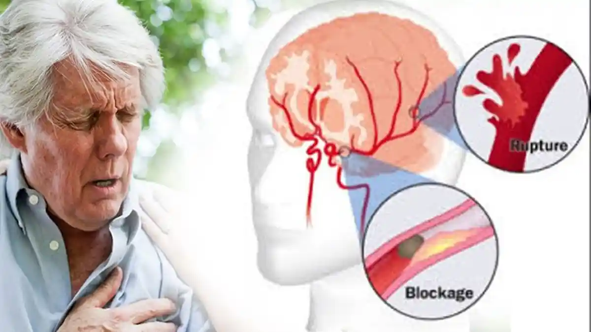 Berikut, 10 Gejala Awal Sebelum Terkena Serangan Stroke yang Jarang Disadari