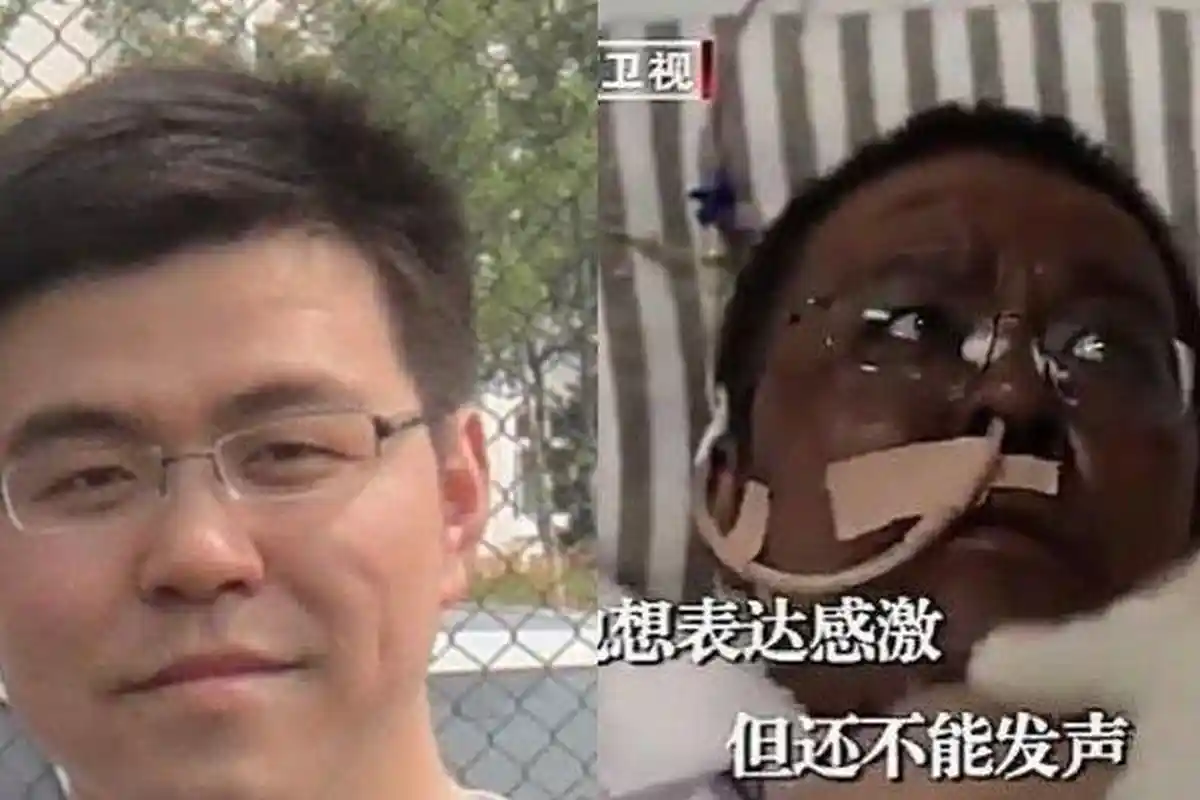 Dokter Hu Weifeng Meninggal Dunia, 4 Bulan Berjuang Melawan Covid-19 Hingga Kulit Wajah Menghitam