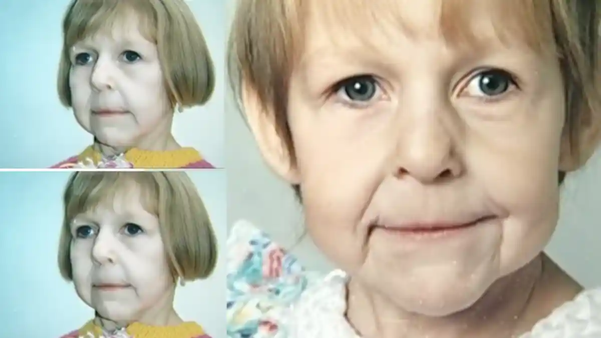 Jadi Korban Bully Karena Menderita Penyakit Langka, Begini Kehidupan Gadis Ini Setelah Dewasa!