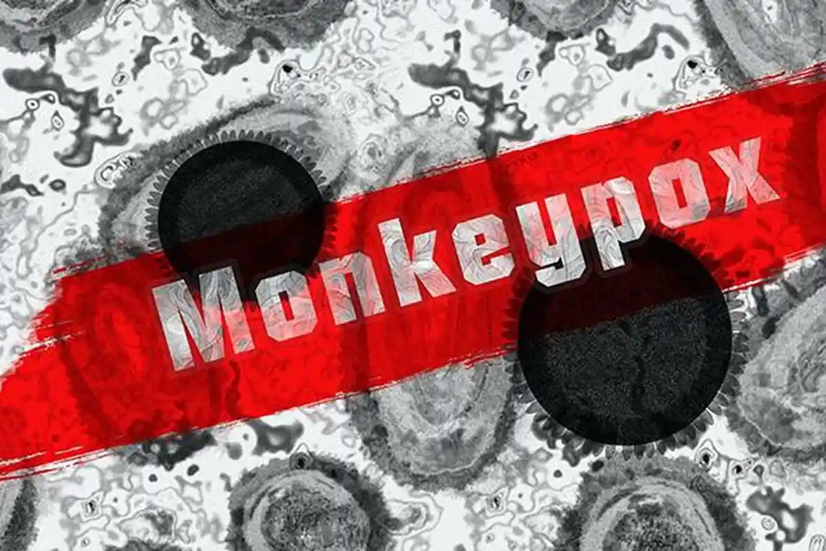 Dikes Temukan Warga di Lombok Tengah Alami Gejala Cacar Monyet, Bagaimana Kondisinya?