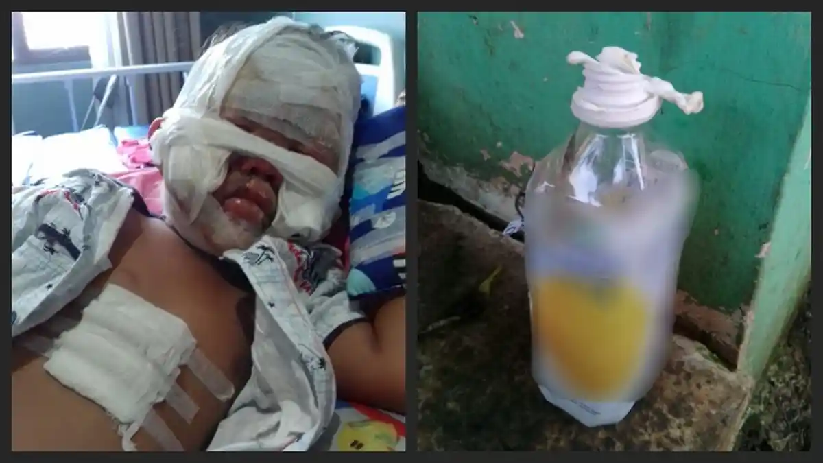 Viral di Medsos, Kisah Pilu Bocah 3 Tahun Tersambar Api Saat Bawa Botol Isi Sisa Hand Sanitizer