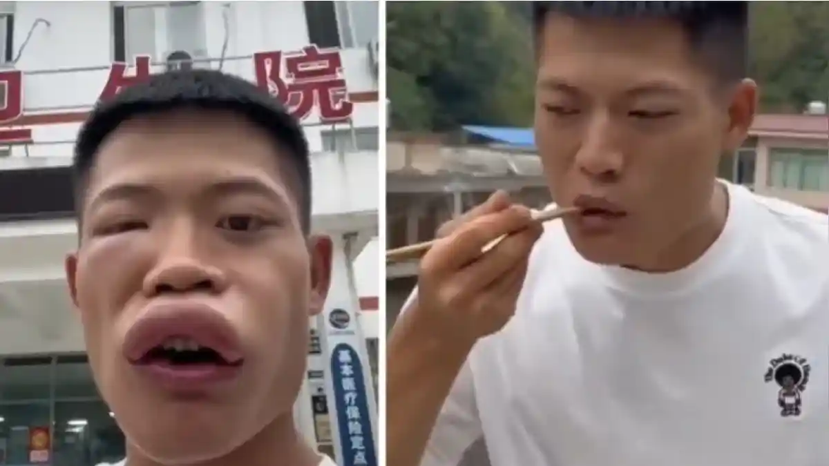 Pria Ini Makan Tawon Hidup-hidup, Bikin Wajahnya Berubah Bentuk, Memble dan Bengkak
